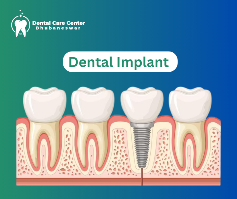 Dental Implant in Bhubaneswar - Dental Care Center Bhubaneswar