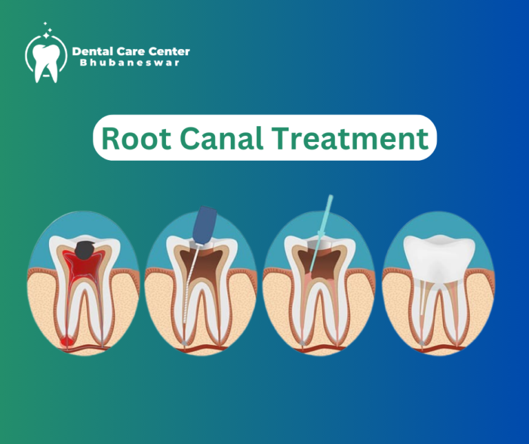 Root Canal Treatment- Dental Care Center Bhubaneswar