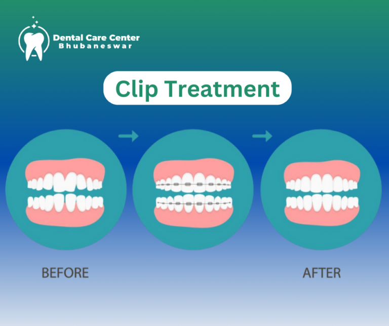 Clip Treatment in Bhubaneswar - Dental Care center Bhubaneswar